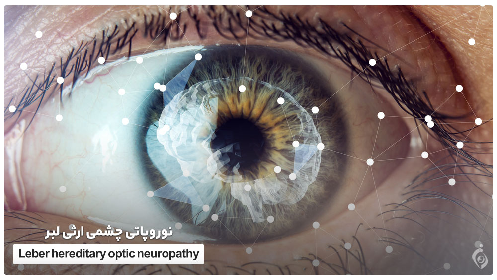 نوروپاتی چشمی ارثی لبر