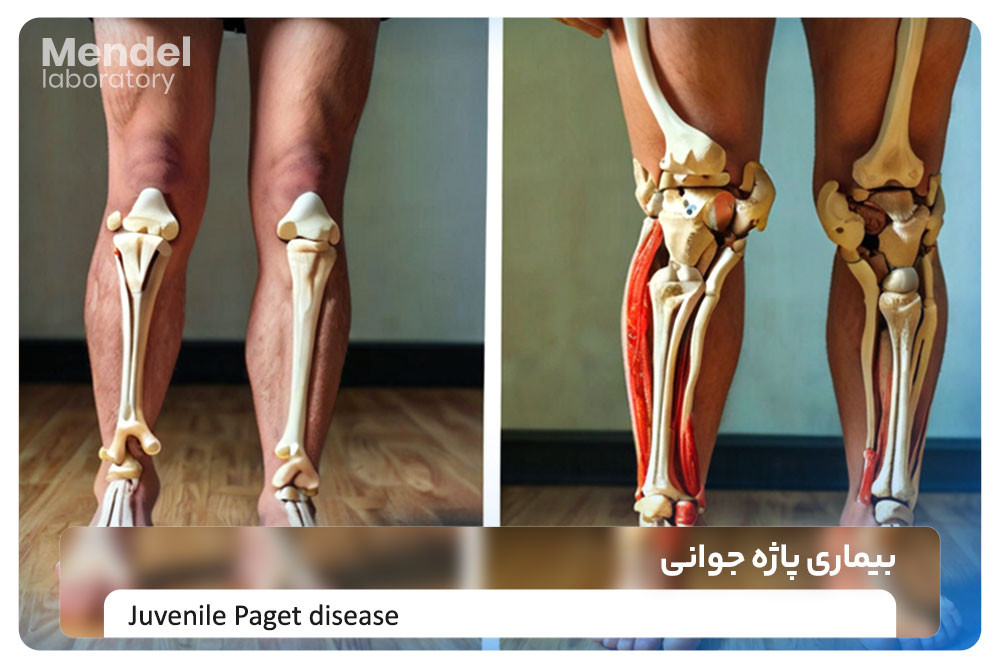 بیماری پاژه جوانی